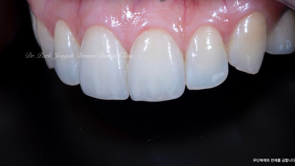 라미네이트 제작 방식에 따른 차이