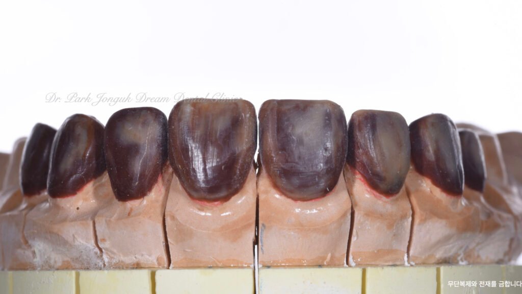 라미네이트 제작 방식에 따른 차이