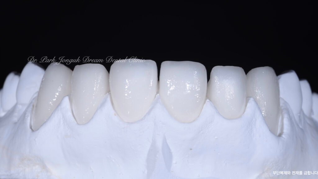 라미네이트 제작 방식에 따른 차이