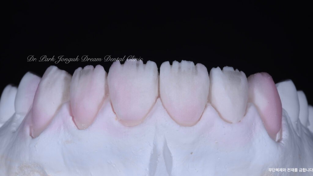 라미네이트 제작 방식에 따른 차이