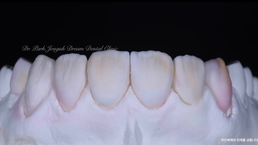 라미네이트 제작 방식에 따른 차이