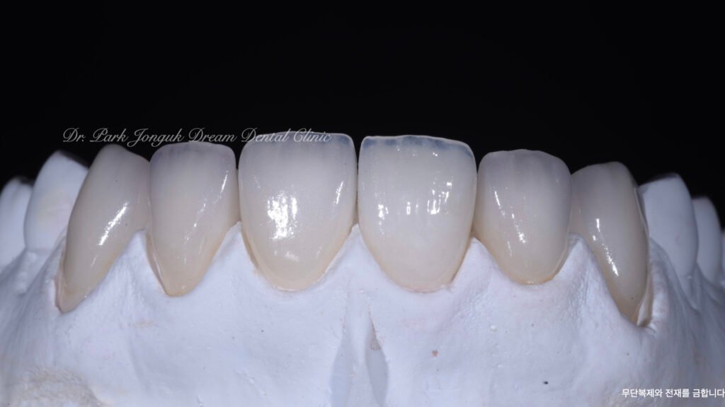 라미네이트 제작 방식에 따른 차이