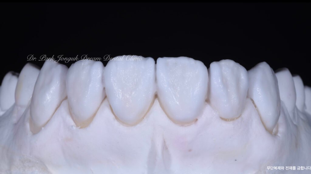 라미네이트 제작 방식에 따른 차이