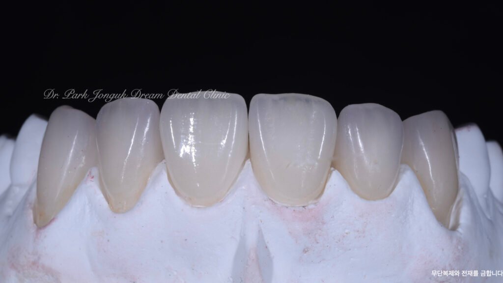 라미네이트 제작 방식에 따른 차이