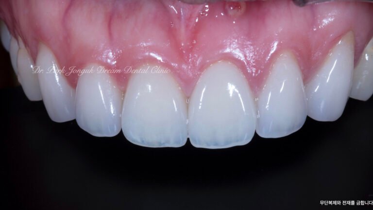 라미네이트 제작 방식에 따른 차이