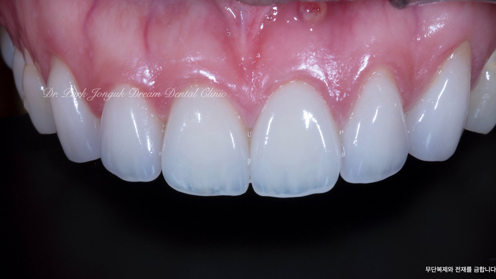 라미네이트 제작 방식에 따른 차이