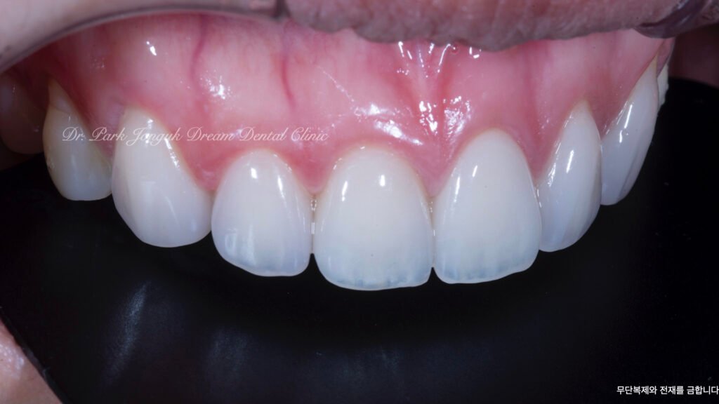 라미네이트 제작 방식에 따른 차이