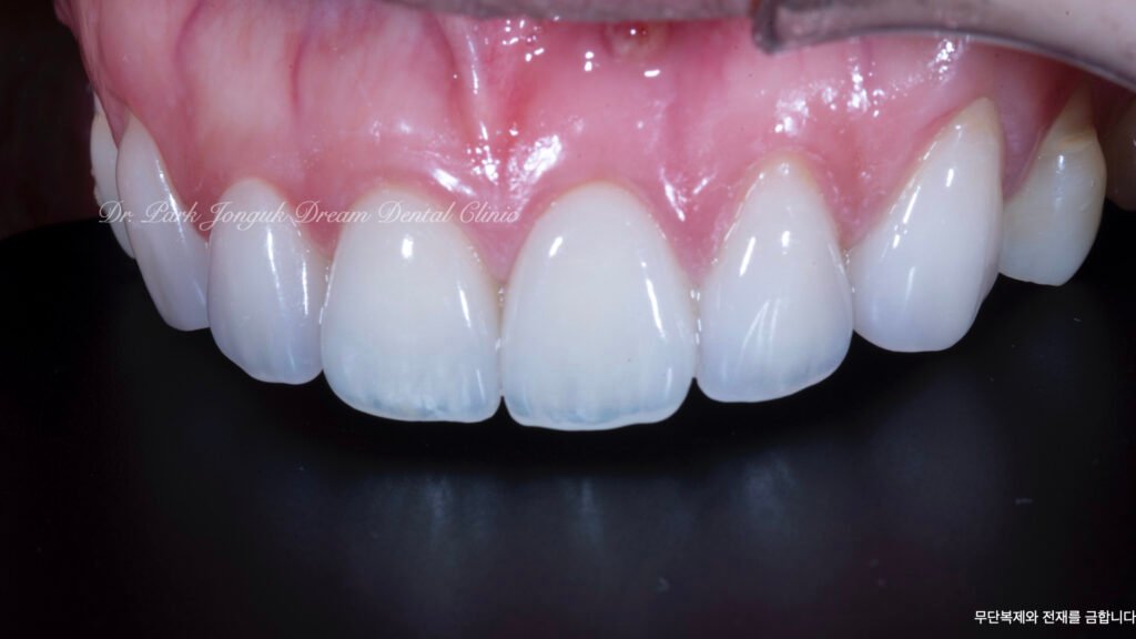 라미네이트 제작 방식에 따른 차이