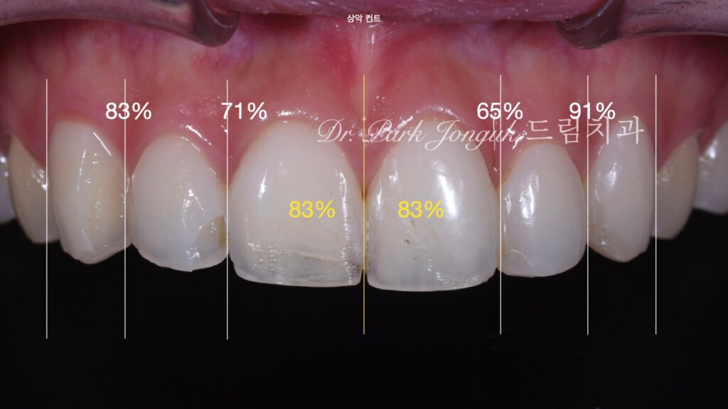 라미네이트-재진단-왁스업