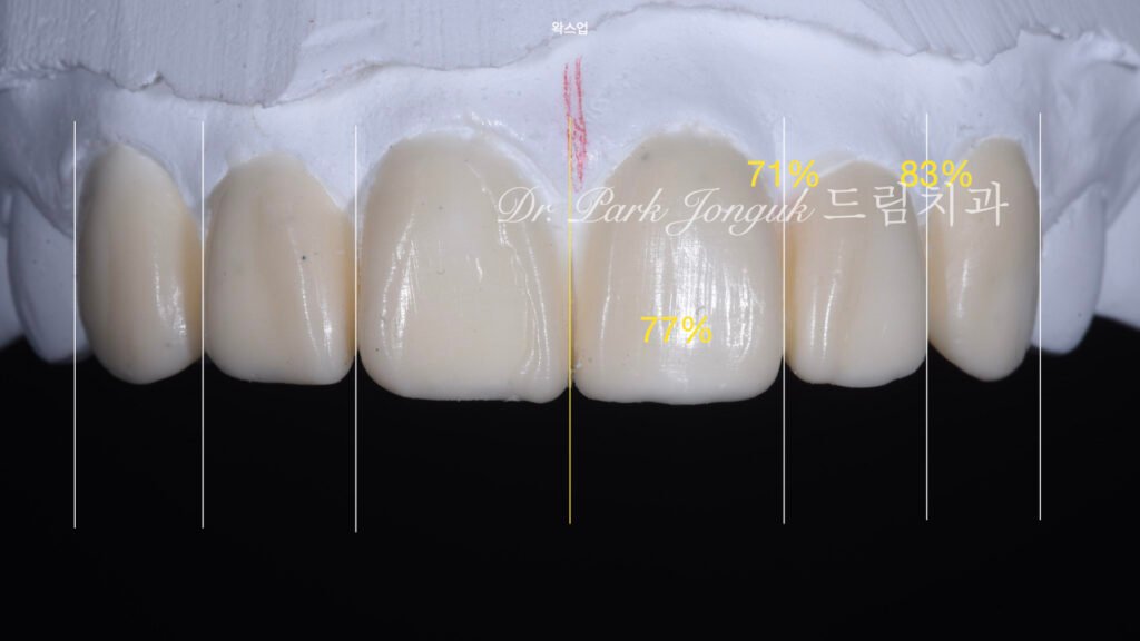 라미네이트-재진단-왁스업