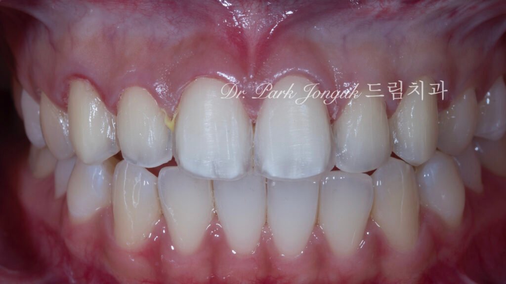 레이저-라미네이트-제거-과정