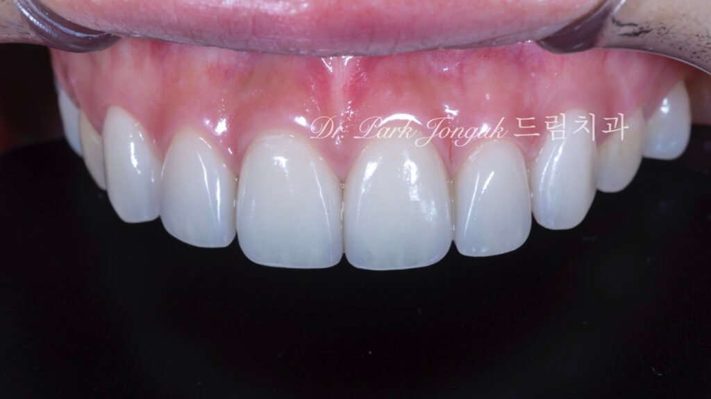 라미네이트-재시술-완료