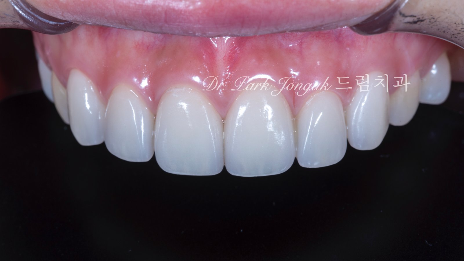 라미네이트-재시술-완료