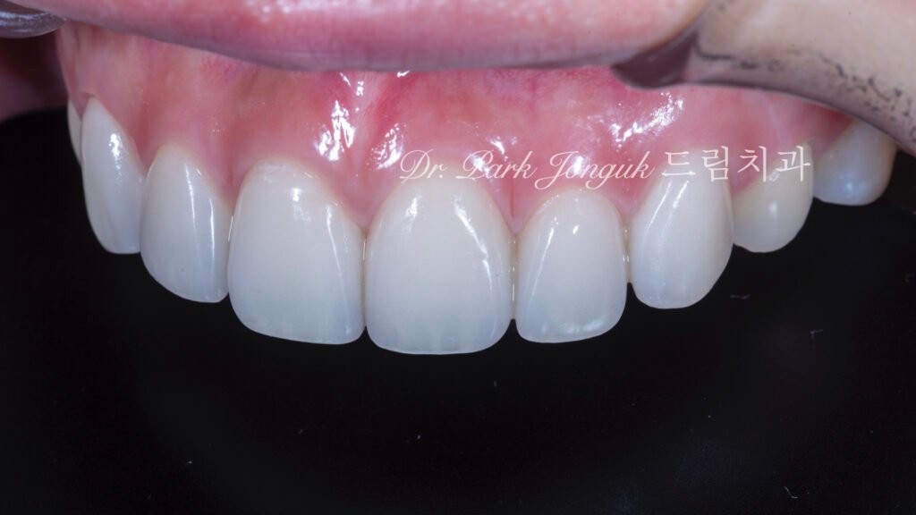 라미네이트-재시술-완료