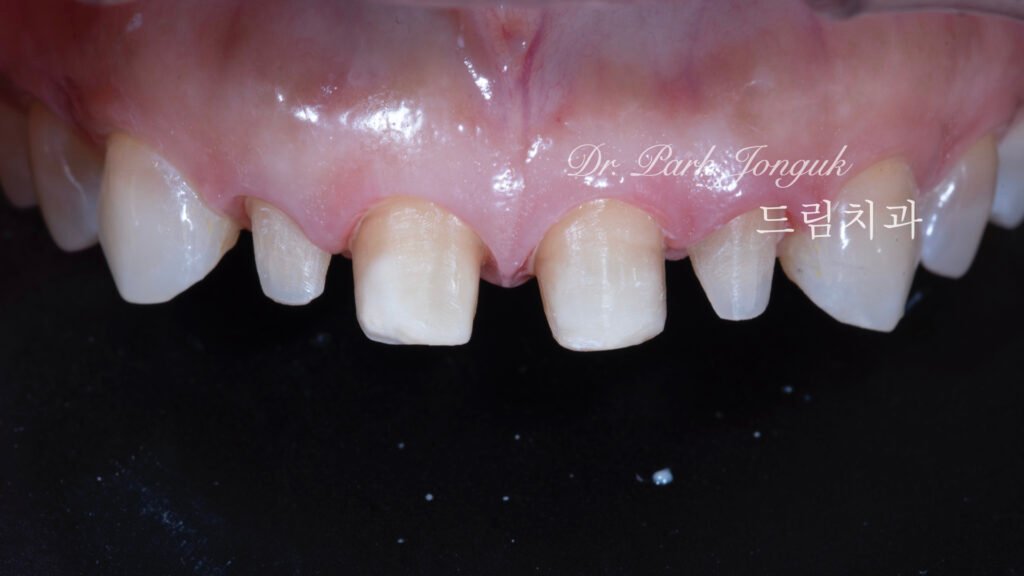 라미네이트제거-과도한삭제-발견