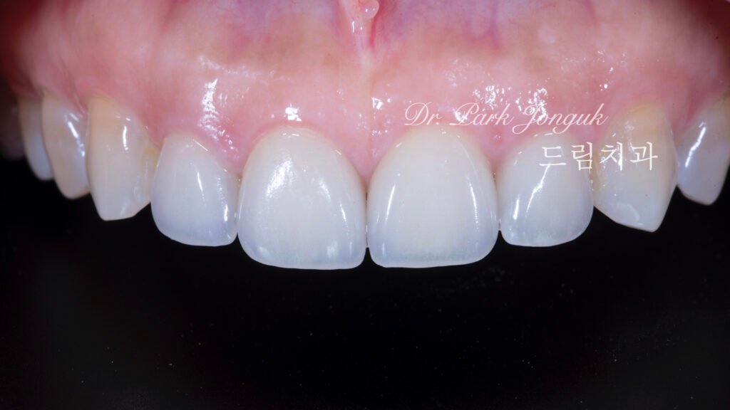 라미네이트재치료-즉시결과