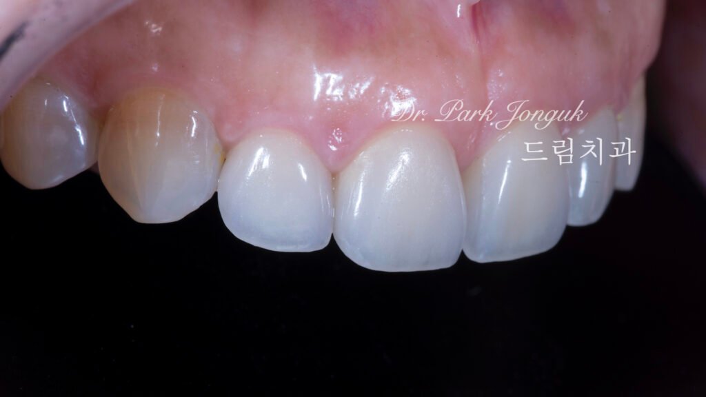 라미네이트재치료-즉시결과