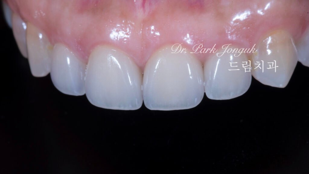 라미네이트재치료-즉시결과