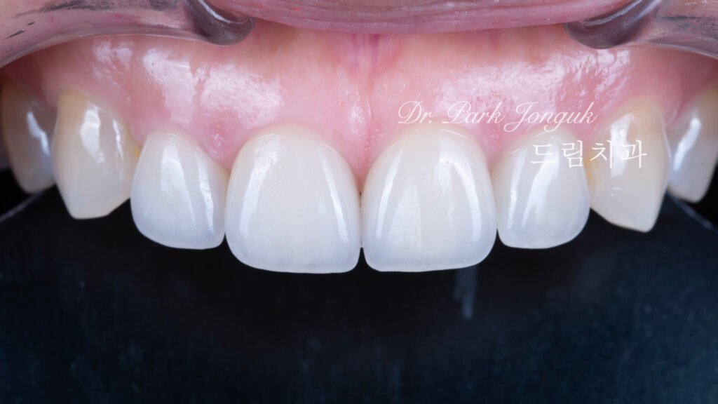 라미네이트재치료-5년추적