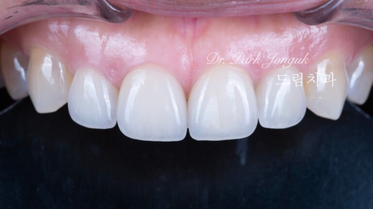 라미네이트재치료-5년추적