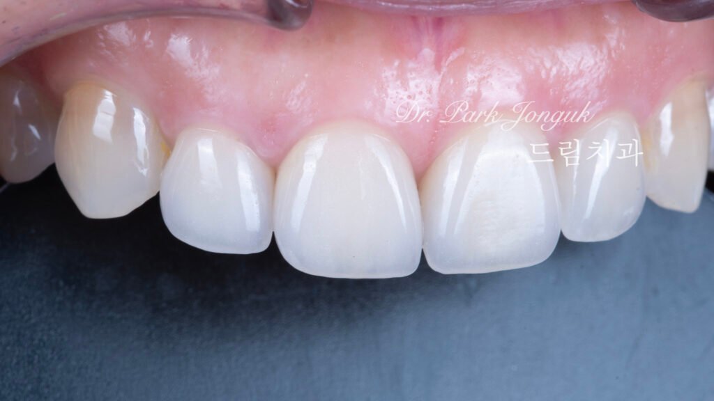 라미네이트재치료-5년추적