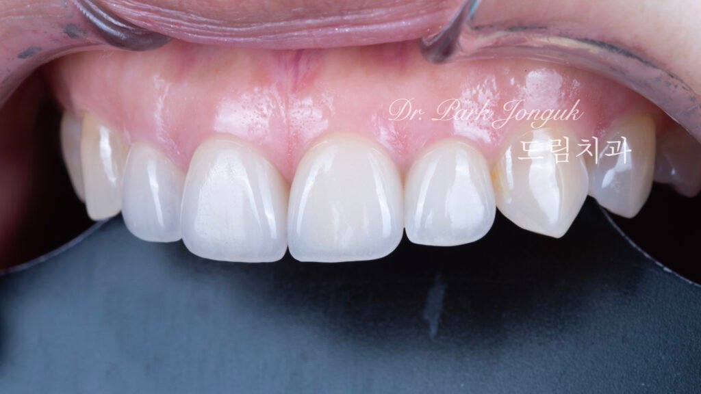 라미네이트재치료-5년추적