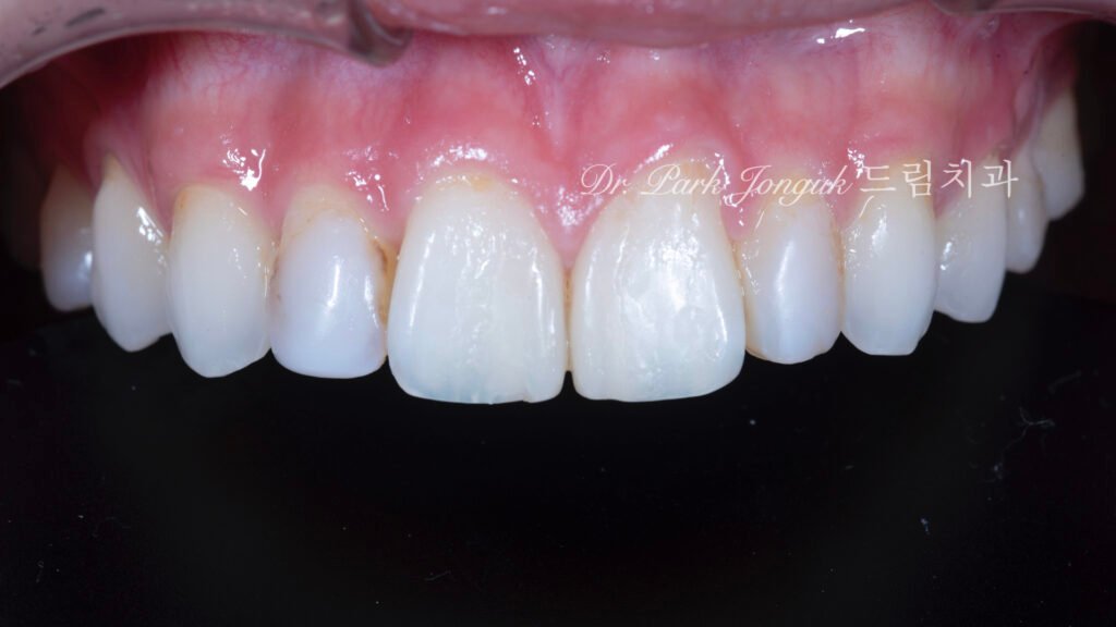 앞니 레진 변색 라미네이트
