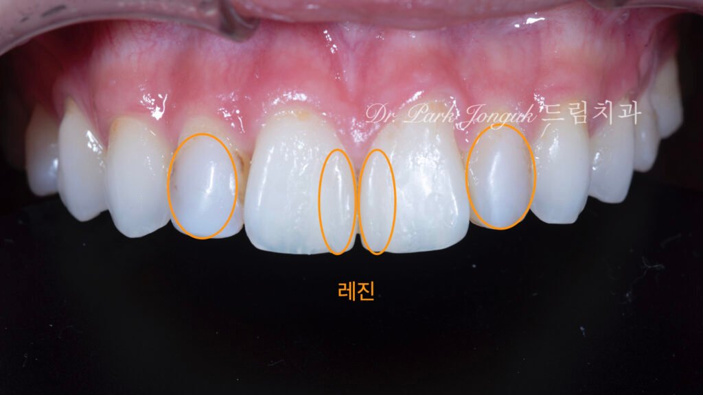 앞니 레진 변색 라미네이트