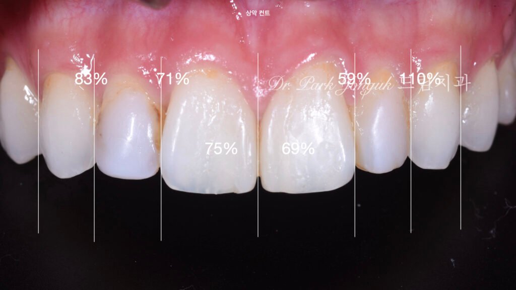 앞니 레진 변색 라미네이트