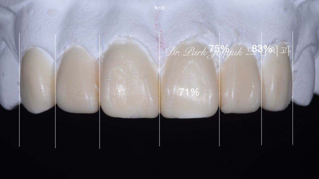 앞니 레진 변색 라미네이트