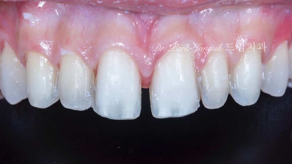 앞니 레진 변색 라미네이트