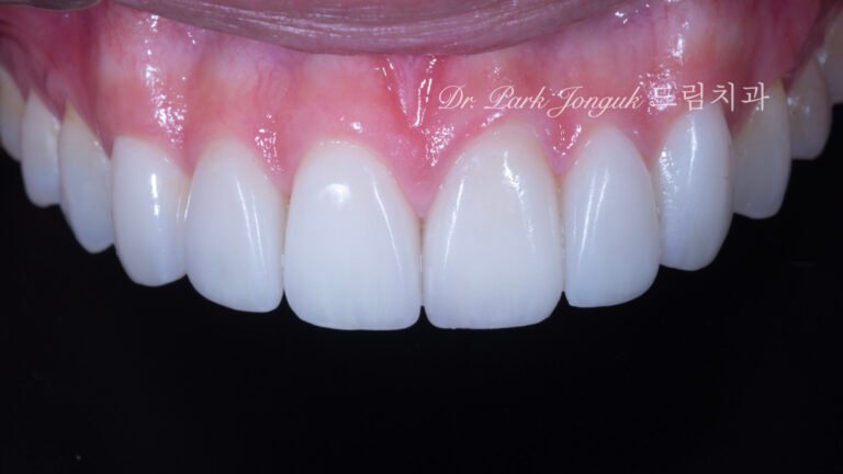 앞니 레진 변색 라미네이트