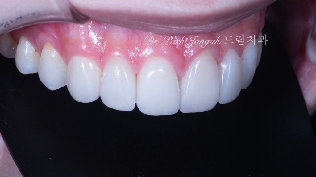 앞니 레진 변색 라미네이트