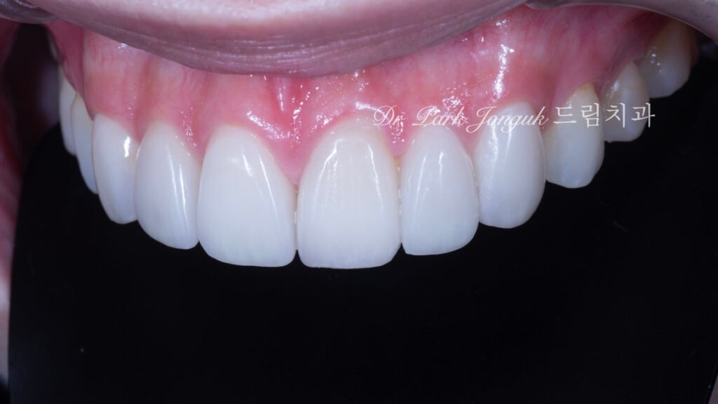 앞니 레진 변색 라미네이트