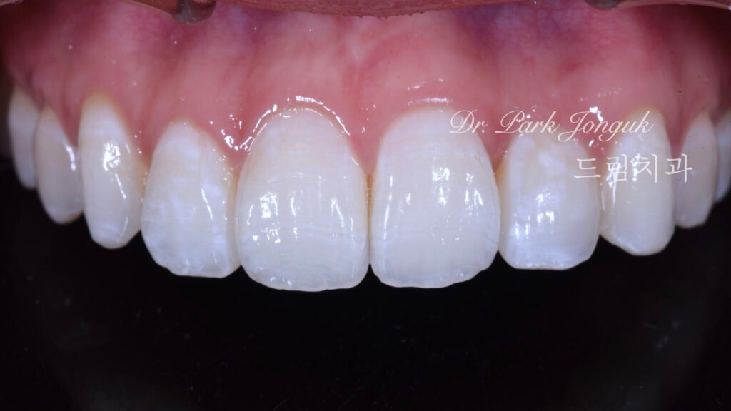 뻐드러진치아 라미네이트