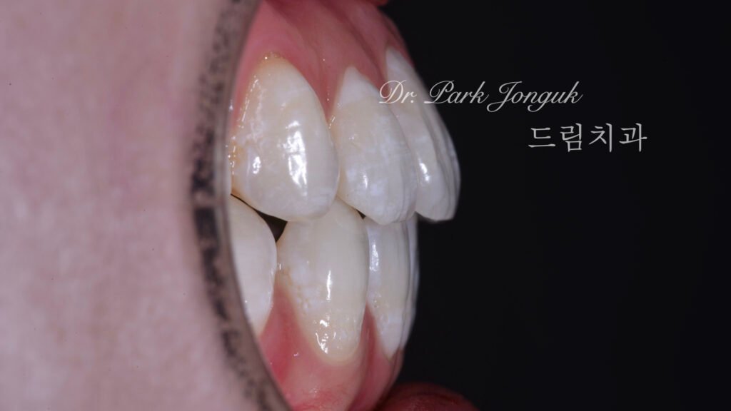 뻐드러진치아 라미네이트