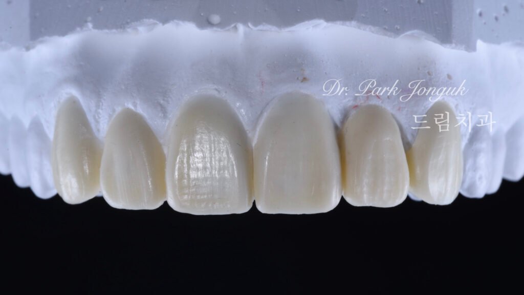 뻐드러진치아 라미네이트