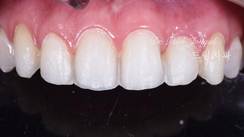 뻐드러진치아 라미네이트