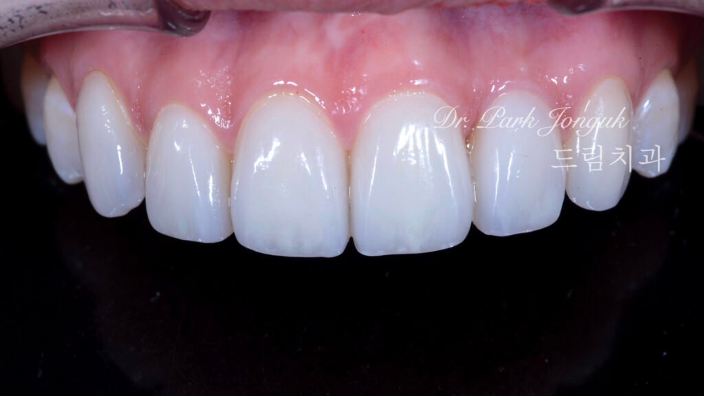 뻐드러진치아 라미네이트