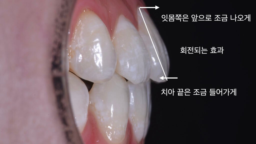 뻐드러진치아 라미네이트