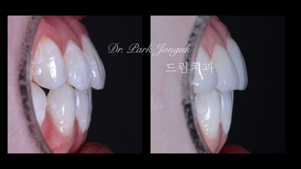 뻐드러진치아 라미네이트