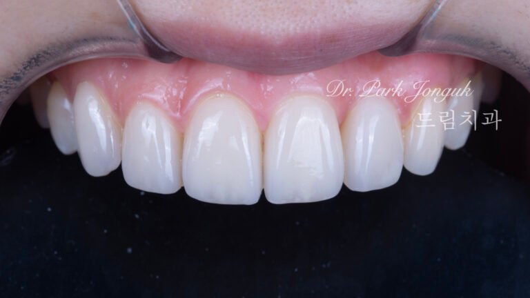 뻐드러진치아 라미네이트
