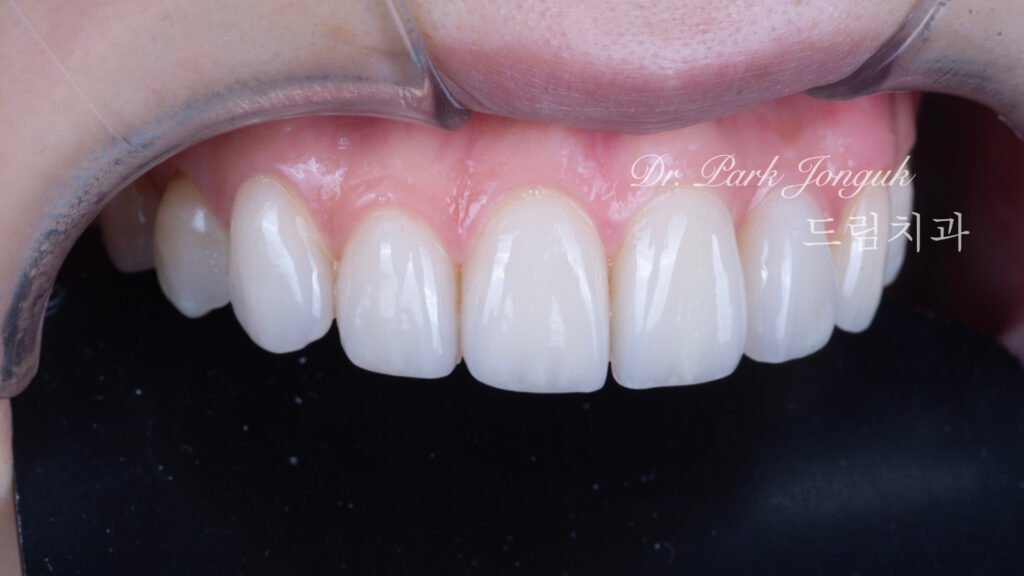 뻐드러진치아 라미네이트