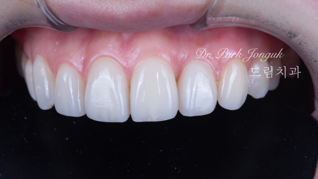 뻐드러진치아 라미네이트