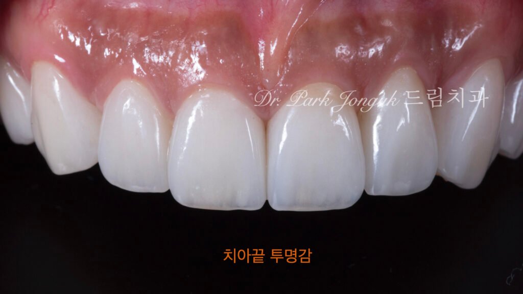 라미네이트-치은조화-자연스러움