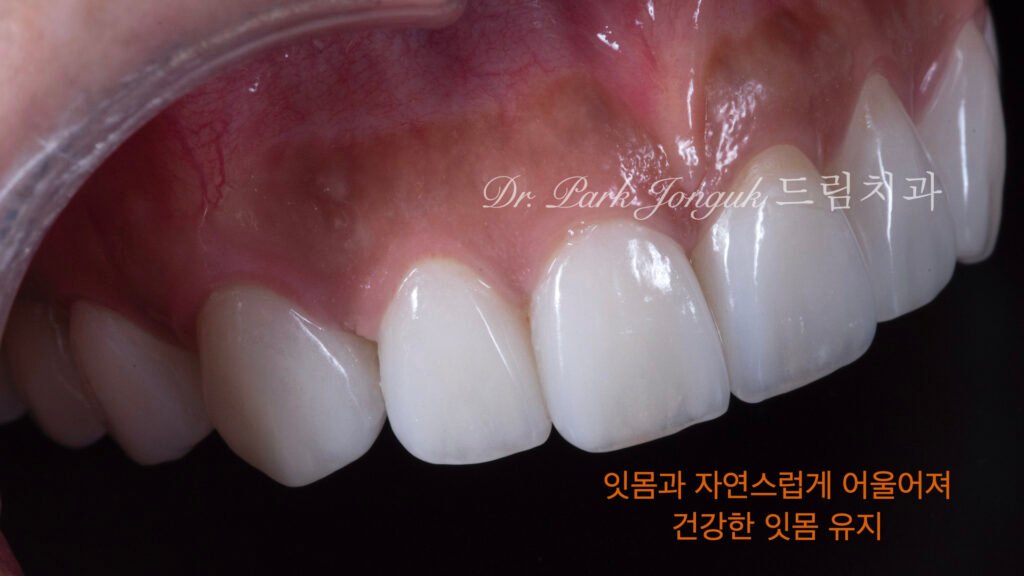 라미네이트-치은조화-자연스러움