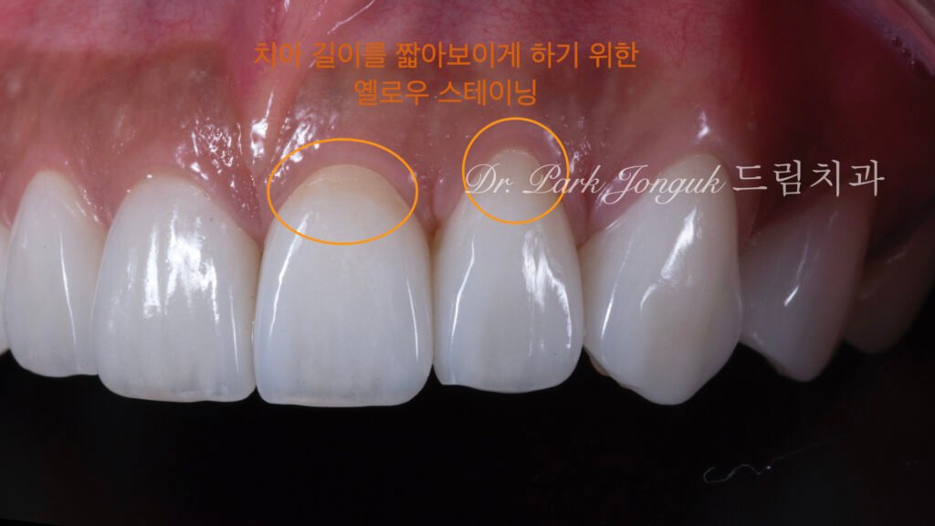 라미네이트-색감조절-길이보정