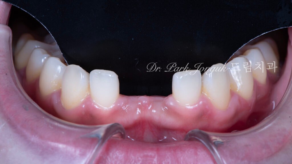 Anterior Maryland Bridge 앞니 메릴랜드 브릿지