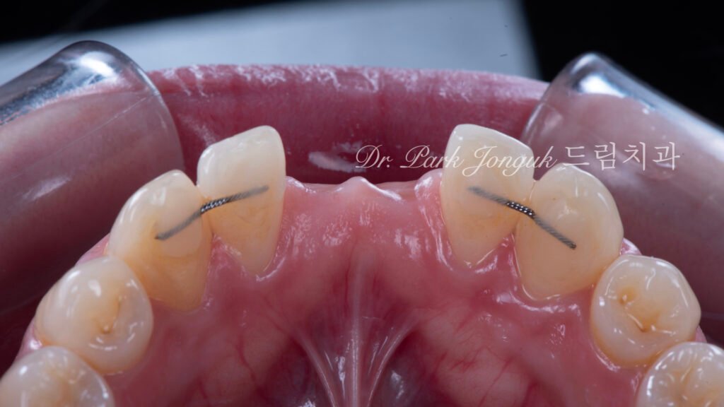 Anterior Maryland Bridge 앞니 메릴랜드 브릿지