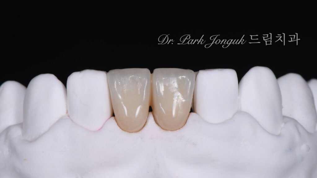 Anterior Maryland Bridge 앞니 메릴랜드 브릿지